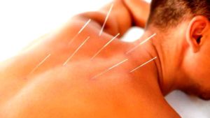 العلاج بالابر الصينية